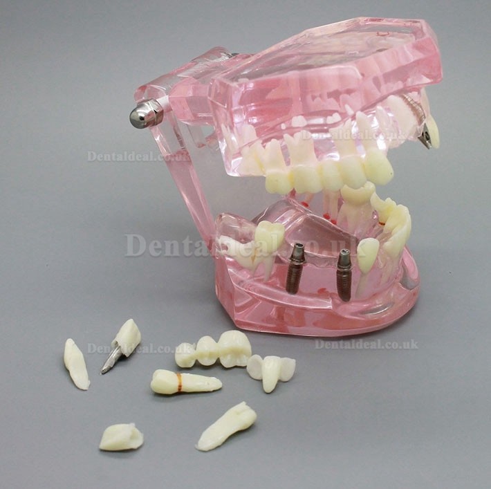 Dental Implant Study Analysis Demonstration Teeth Model with Restoration PINK
