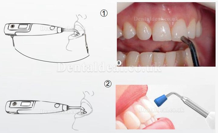 Denjoy MeteEndo Moible Dental Endo Integrated Cart System (with Meta Fill/Meta Pex/Meta Motor/Meta Pulp/Meta Pack) Denjoy MeteEndo Moible Dental Endo Integrated Cart System (with Meta Fill/Meta Pex/Meta Motor/Meta Pulp/Meta Pack)