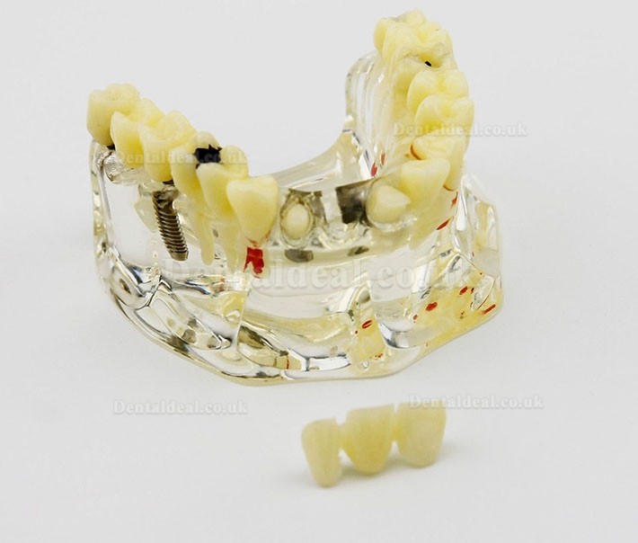 Dental Upper Jaw Implant Model with Bridge and Caries -I 2006