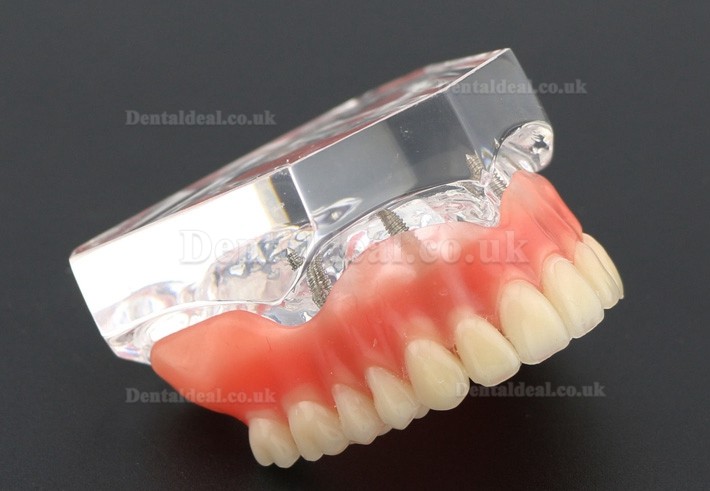 Dental Study Teeth Model Overdenture With 4 Implants Demo Model 6001 Dental Study Teeth Model Overdenture With 4 Implants Demo Model 6001