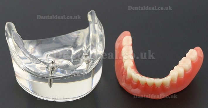 Dental Teeth Model Overdenture Inferior with 2 Implants Study Demo Model 6002 01 Dental Teeth Model Overdenture Inferior with 2 Implants Study Demo Model 6002 01