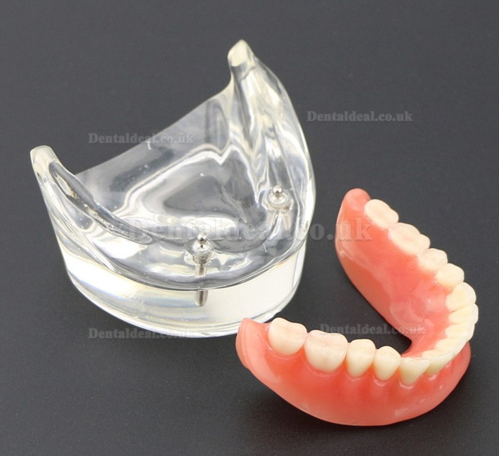 Dental Teeth Model Overdenture Inferior with 2 Implants Study Demo Model 6002 01 Dental Teeth Model Overdenture Inferior with 2 Implants Study Demo Model 6002 01