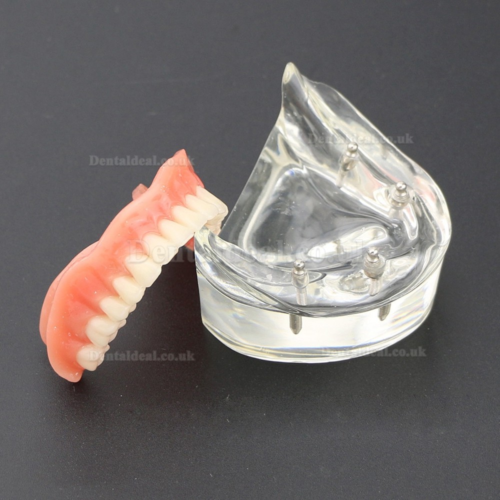 Dental Lower Teeth Demo Study Model 6002 02 Overdenture Inferior 4 Implants Dental Lower Teeth Demo Study Model 6002 02 Overdenture Inferior 4 Implants