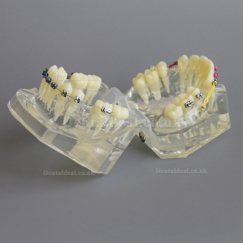 Dental Orthodontic Demonstration Practice Model With Metal Bracket Archwire