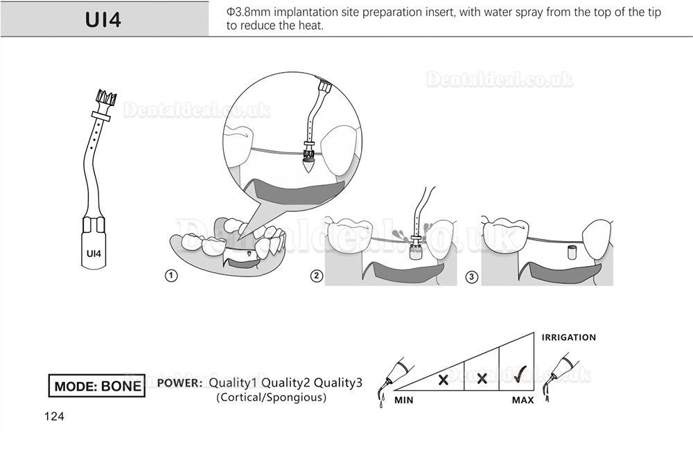 1Pcs Dental Piezosurgery Insert Tips Implant Ul1 UI2 UI3 UI4 UI5 Fit Mectron Woodpecker